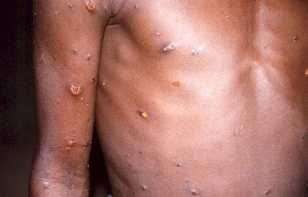 en-argentina-hay-cinco-casos-detectados-de-viruela-del-mono-o-mpox:-como-se-prepara-cordoba